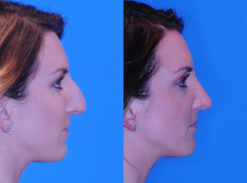 Rhinoplasty Before & After - Dr. Mark A. Clymer - Nashville, TN