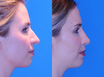 Rhinoplasty Before & After - Dr. Mark A. Clymer - Nashville, TN