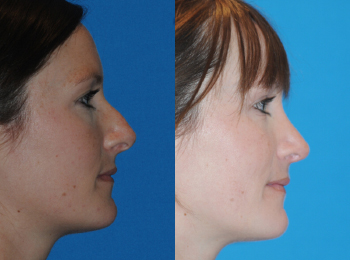 Rhinoplasty Before & After - Dr. Mark A. Clymer - Nashville, TN