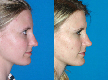 Rhinoplasty Before & After - Dr. Mark A. Clymer - Nashville, TN