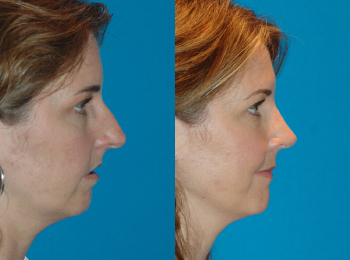 Rhinoplasty Before & After - Dr. Mark A. Clymer - Nashville, TN