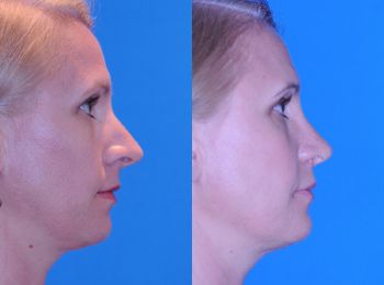 Rhinoplasty Before & After - Dr. Mark A. Clymer - Nashville, TN
