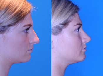 Rhinoplasty Before & After - Dr. Mark A. Clymer - Nashville, TN