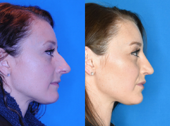 Rhinoplasty Before & After - Dr. Mark A. Clymer - Nashville, TN