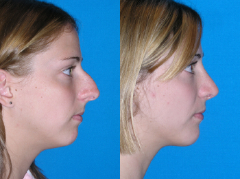 Rhinoplasty Before & After - Dr. Mark A. Clymer - Nashville, TN