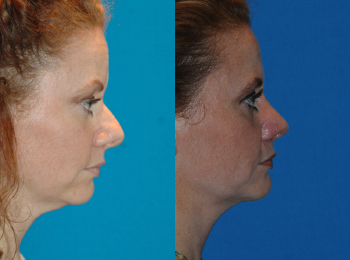Rhinoplasty Before & After - Dr. Mark A. Clymer - Nashville, TN