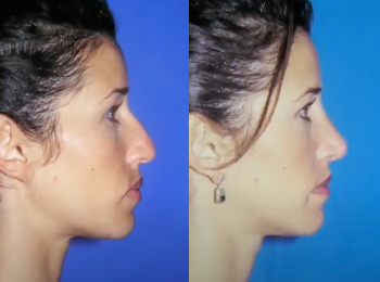Rhinoplasty Before & After - Dr. Mark A. Clymer - Nashville, TN