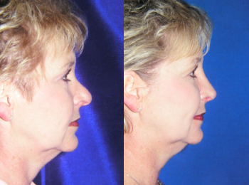Rhinoplasty Before & After - Dr. Mark A. Clymer - Nashville, TN