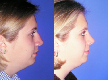 Rhinoplasty Before & After - Dr. Mark A. Clymer - Nashville, TN