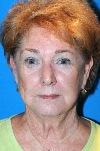 Facelift Before - Dr. Mark A. Clymer - Nashville, TN