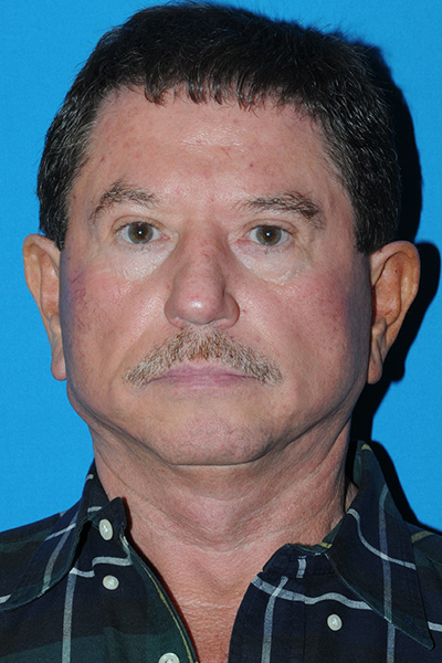 Facelift Before - Dr. Mark A. Clymer - Nashville, TN