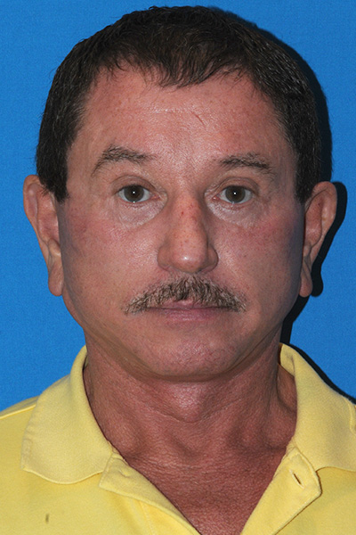 Facelift After - Dr. Mark A. Clymer - Nashville, TN