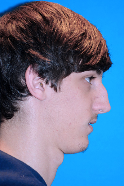 Rhinoplasty Before - Dr. Mark A. Clymer - Nashville, TN
