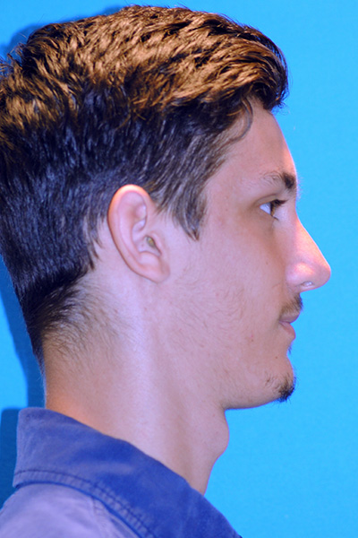 Rhinoplasty After - Dr. Mark A. Clymer - Nashville, TN