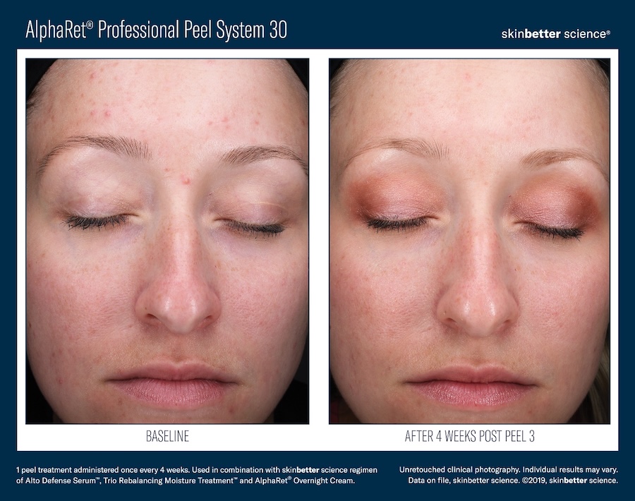AlphaRet Professional Peel - Clymer Facial Plastic Surgery