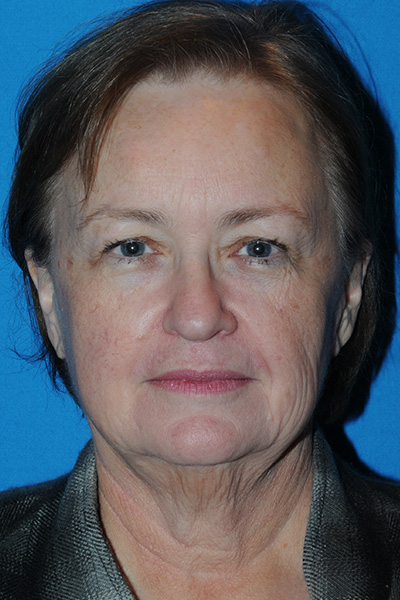 Brow Lift Before - Dr. Mark A. Clymer - Nashville, TN