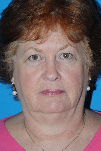 Eyelid Lift Before - Dr. Mark A. Clymer - Nashville, TN