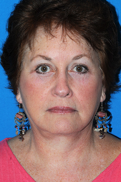 Eyelid Lift After - Dr. Mark A. Clymer - Nashville, TN