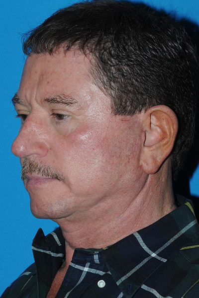 Facelift Before - Dr. Mark A. Clymer - Nashville, TN