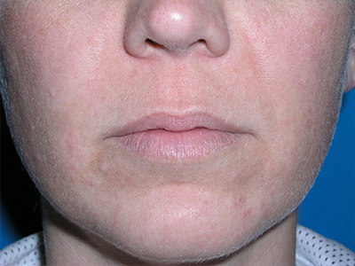 Lip Lift Before - Dr. Mark A. Clymer - Nashville, TN