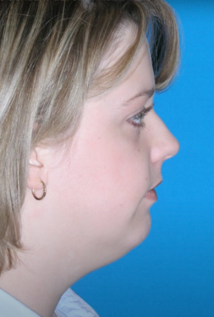 Neck Contouring Before - Dr. Mark A. Clymer - Nashville, TN