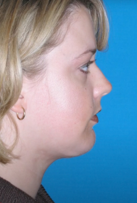 Neck Contouring After - Dr. Mark A. Clymer - Nashville, TN