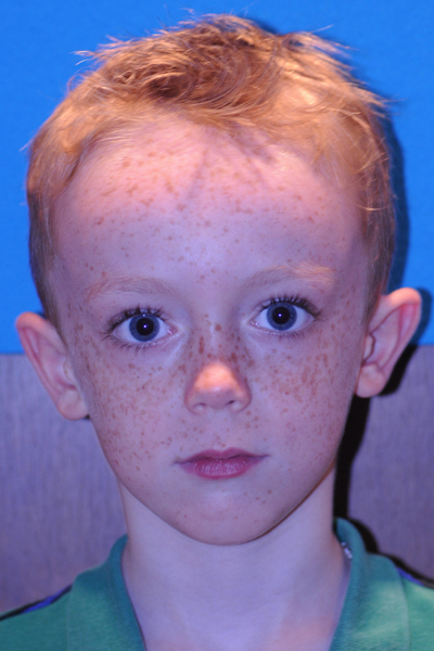 Otoplasty Before - Dr. Mark A. Clymer - Nashville, TN