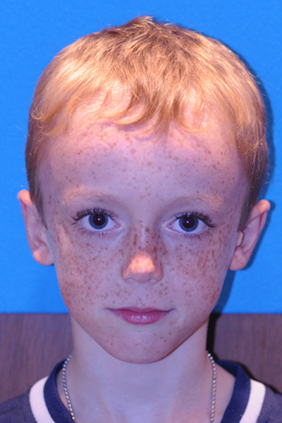 Otoplasty Before - Dr. Mark A. Clymer - Nashville, TN