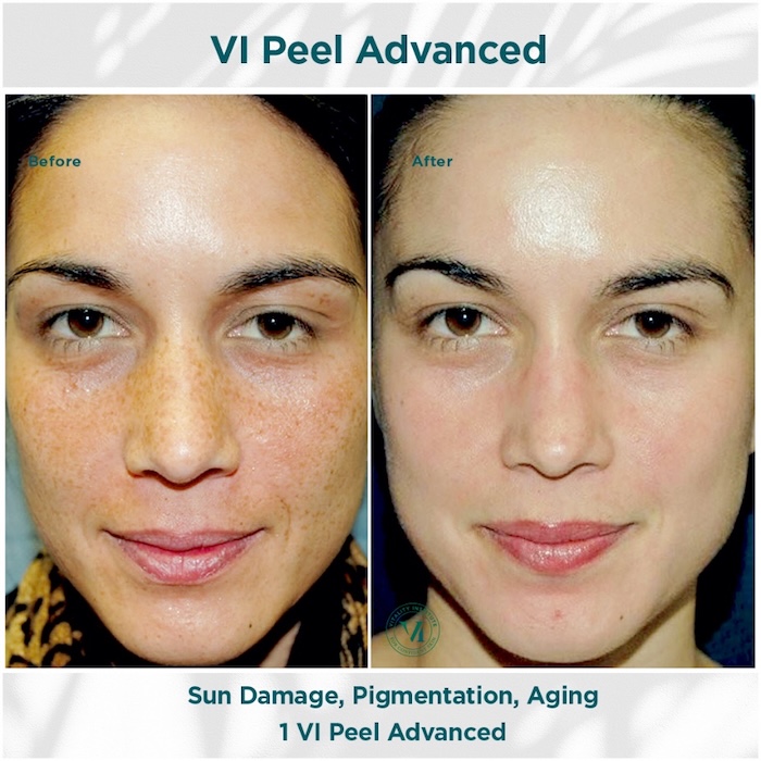 VI Peel ADvanced - Clymer Facial Plastic Surgery