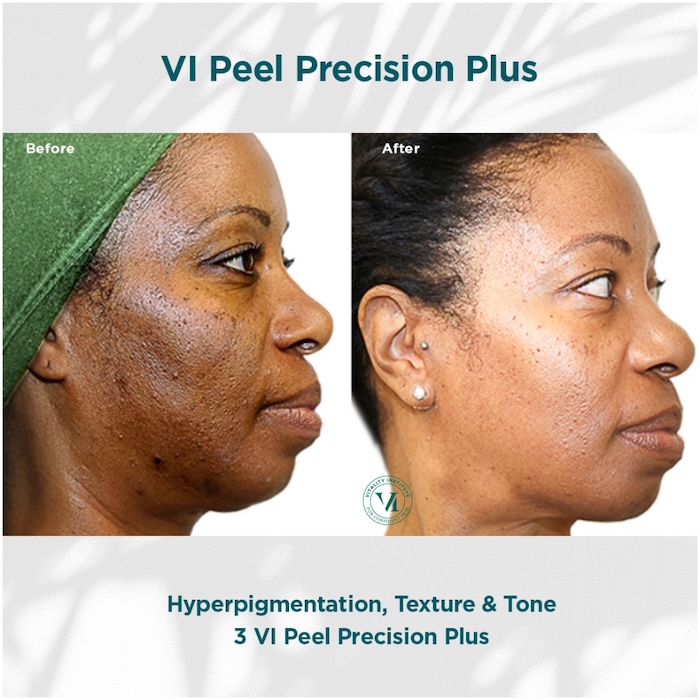 VI Peel Precision Plus before and after - Clymer Facial Plastic Surgery