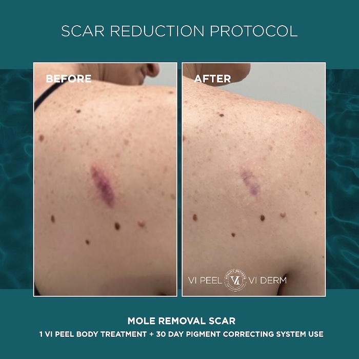 VI Peel Scar Reduction before and after - Clymer Facial Plastic Surgery