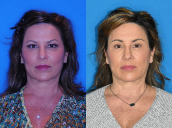 Brow Lift Before & After - Dr. Mark A. Clymer - Nashville, TN