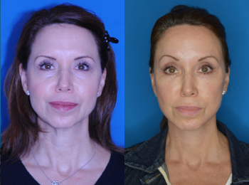 Brow Lift Before & After - Dr. Mark A. Clymer - Nashville, TN