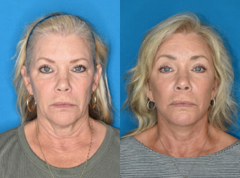 Brow Lift Before & After - Dr. Mark A. Clymer - Nashville, TN