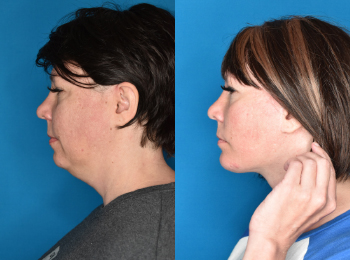 Chin Augmentation Before & After - Dr. Mark A. Clymer - Nashville, TN