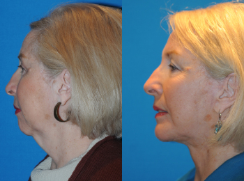 Chin Augmentation Before & After - Dr. Mark A. Clymer - Nashville, TN