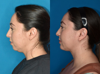 Chin Augmentation Before & After - Dr. Mark A. Clymer - Nashville, TN