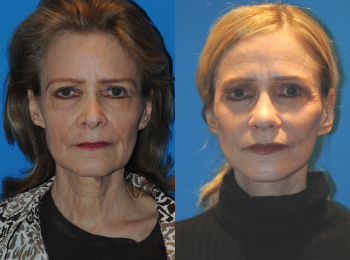 Eyelid Lift Before & After - Dr. Mark A. Clymer - Nashville, TN