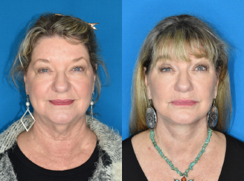 Facelift Before & After - Dr. Mark A. Clymer - Nashville, TN