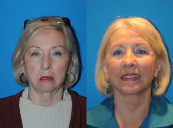 Facelift Before & After - Dr. Mark A. Clymer - Nashville, TN