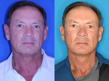 Facelift Before & After - Dr. Mark A. Clymer - Nashville, TN