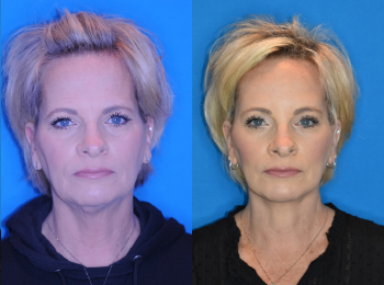 Facelift Before & After - Dr. Mark A. Clymer - Nashville, TN