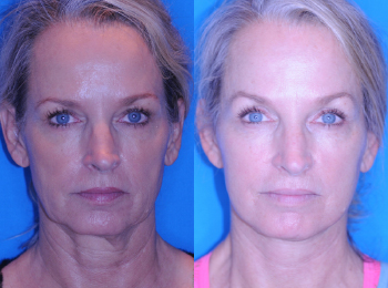 Facelift Before & After - Dr. Mark A. Clymer - Nashville, TN
