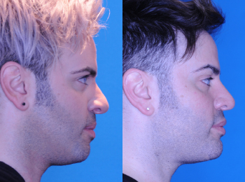 Jaw Augmentation Before & After - Dr. Mark A. Clymer - Nashville, TN