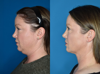 Neck Contouring Before & After - Dr. Mark A. Clymer - Nashville, TN