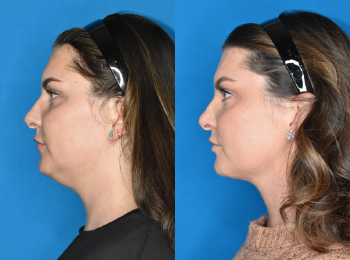 Neck Contouring Before & After - Dr. Mark A. Clymer - Nashville, TN