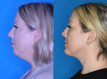Neck Contouring Before & After - Dr. Mark A. Clymer - Nashville, TN