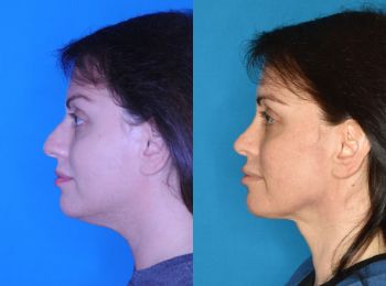 Neck Contouring Before & After - Dr. Mark A. Clymer - Nashville, TN