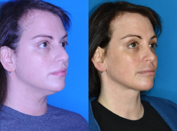 Rhinoplasty Before & After - Dr. Mark A. Clymer - Nashville, TN