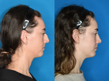 Rhinoplasty Before & After - Dr. Mark A. Clymer - Nashville, TN